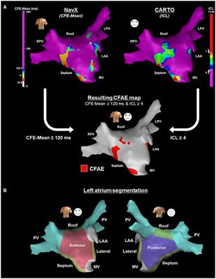 Atrial Electrogram Fractionation Distribution before and after Pulmonary Vein Isolation in Human Persistent Atrial Fibrillation—A Retrospective Multivariate Statistical Analysis